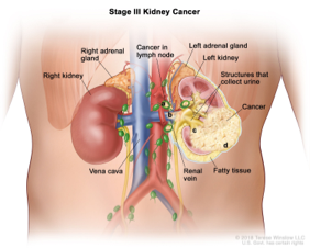 KEYTRUDA® (pembrolizumab) Is Approved as an Adjuvant Treatment for Certain Patients With Kidney Cancer (Renal Cell Carcinoma)