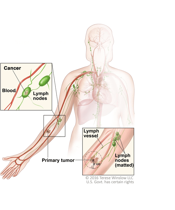For Patients With Stage 3 Melanoma, KEYTRUDA® (pembrolizumab) Is an Immunotherapy Approved by the FDA to Help Prevent Your Melanoma From Coming Back After It and Lymph Nodes That Contain Cancer Have Been Removed By Surgery